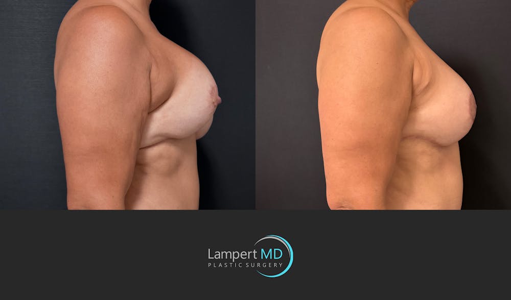 Breast Revision Before & After Gallery - Patient 399570 - Image 4