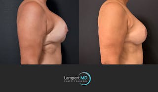 Breast Revision Before & After Gallery - Patient 399570 - Image 4