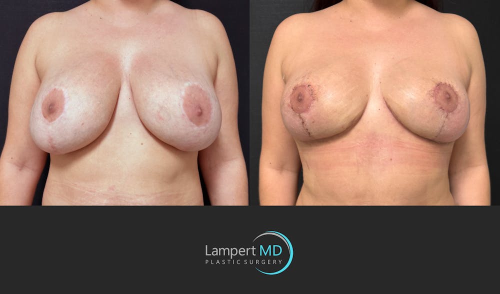 Breast Revision Before & After Gallery - Patient 165425 - Image 1