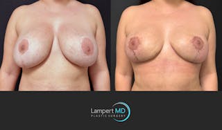 Breast Revision Before & After Gallery - Patient 165425 - Image 1