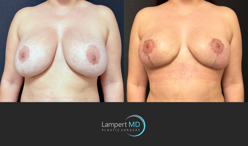 Breast Revision Before & After Gallery - Patient 165425 - Image 2