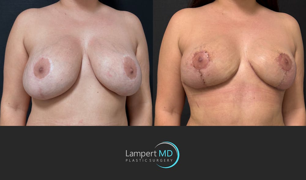 Breast Revision Before & After Gallery - Patient 165425 - Image 3
