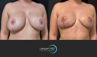 Breast Revision Before & After Gallery - Patient 165425 - Image 3