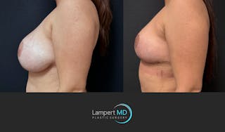 Breast Revision Before & After Gallery - Patient 165425 - Image 4