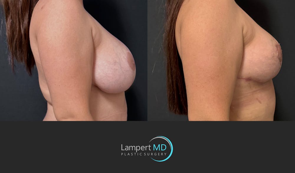 Breast Revision Before & After Gallery - Patient 165425 - Image 5