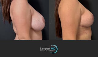 Breast Revision Before & After Gallery - Patient 165425 - Image 5