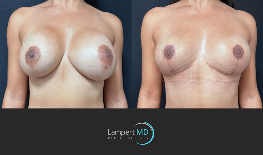Breast Fat Transfer Before & After Gallery - Patient 172007 - Image 1