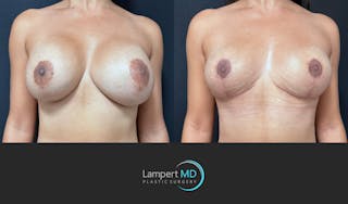 Breast Fat Transfer Before & After Gallery - Patient 172007 - Image 1