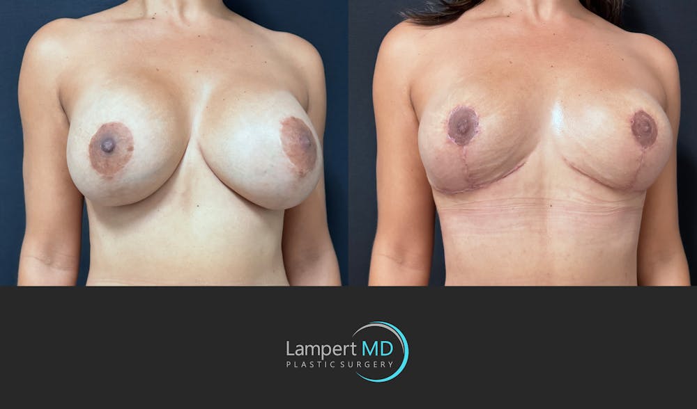 Breast Fat Transfer Before & After Gallery - Patient 172007 - Image 2