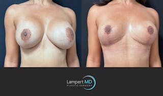 Breast Fat Transfer Before & After Gallery - Patient 172007 - Image 2