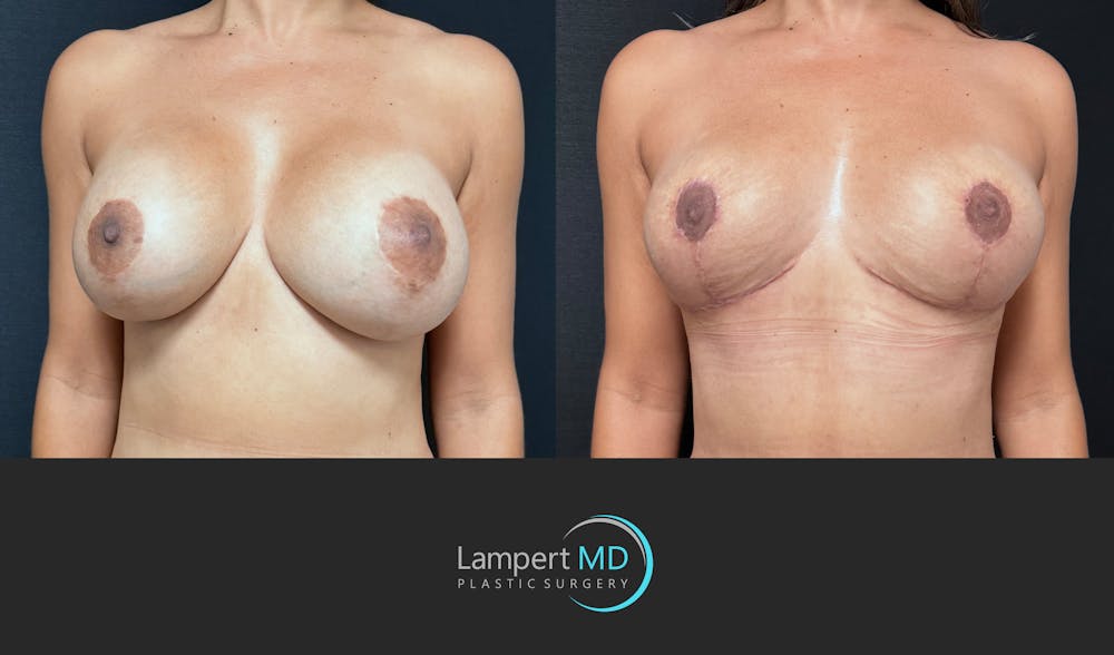 Breast Fat Transfer Before & After Gallery - Patient 172007 - Image 3
