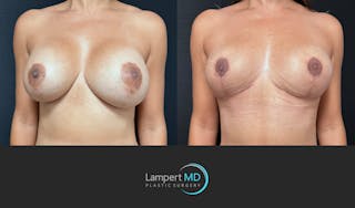 Breast Fat Transfer Before & After Gallery - Patient 172007 - Image 3