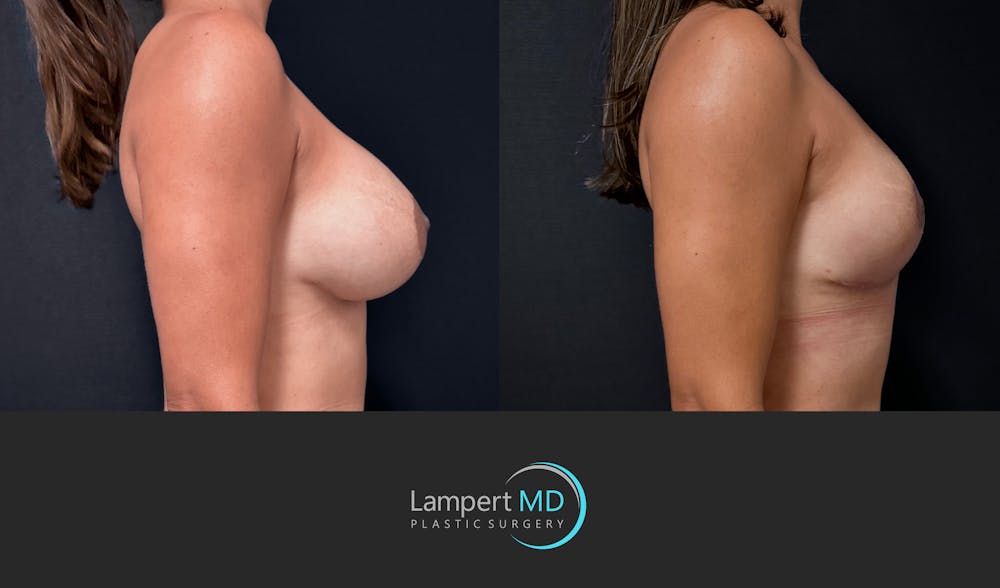 Breast Fat Transfer Before & After Gallery - Patient 172007 - Image 4