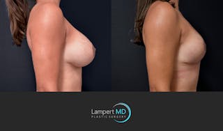 Breast Fat Transfer Before & After Gallery - Patient 172007 - Image 4