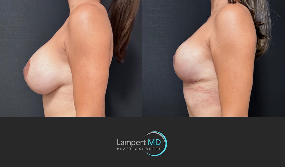 Breast Fat Transfer Before & After Gallery - Patient 172007 - Image 5