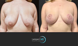 Breast Lift Before & After Gallery - Patient 219334 - Image 1