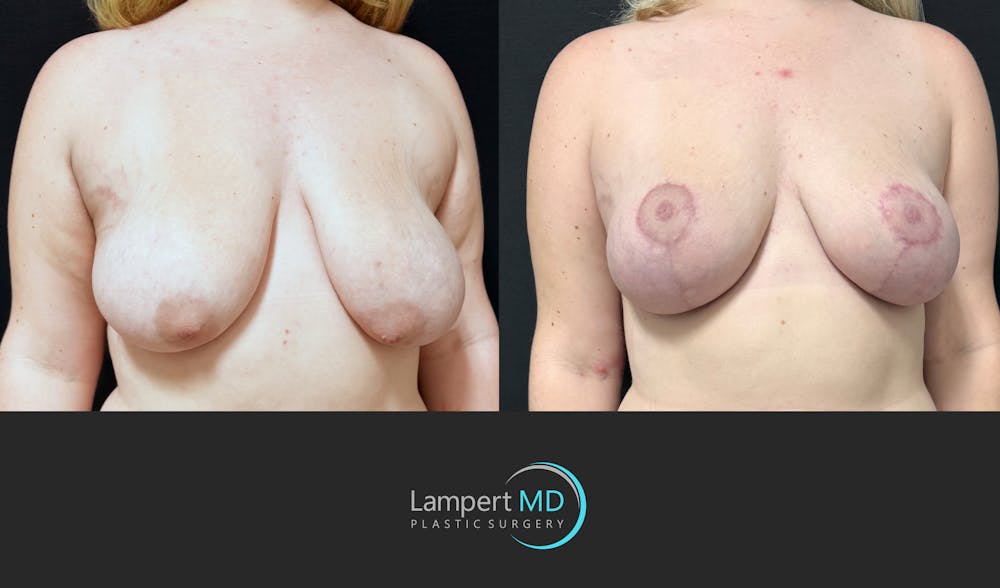 Breast Lift Before & After Gallery - Patient 219334 - Image 2