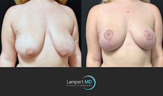Breast Lift Before & After Gallery - Patient 219334 - Image 2