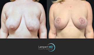 Breast Lift Before & After Gallery - Patient 219334 - Image 3
