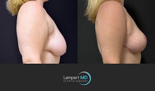 Breast Lift Before & After Gallery - Patient 219334 - Image 4