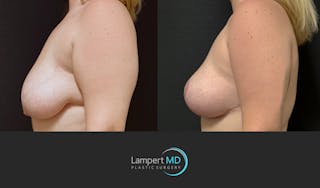 Breast Lift Before & After Gallery - Patient 219334 - Image 5
