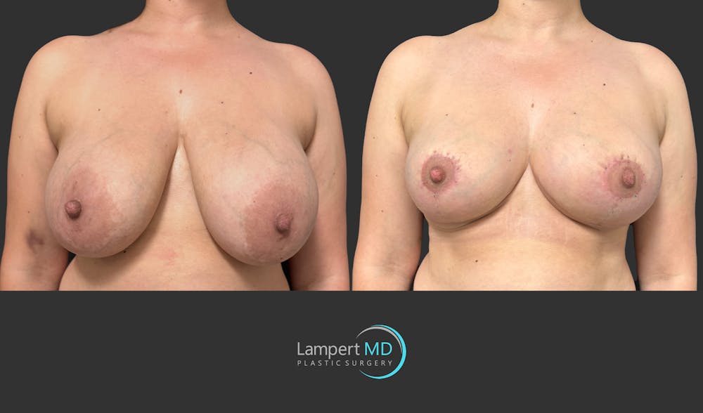 Breast Lift Before & After Gallery - Patient 230635 - Image 2