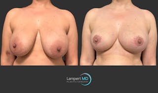 Breast Lift Before & After Gallery - Patient 230635 - Image 1