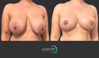 Breast Lift Before & After Gallery - Patient 230635 - Image 3