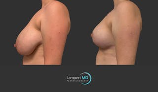 Breast Lift Before & After Gallery - Patient 230635 - Image 5