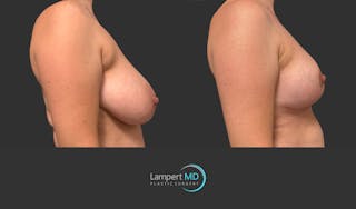 Breast Lift Before & After Gallery - Patient 230635 - Image 4
