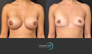 Breast Lift Before & After Gallery - Patient 428959 - Image 1