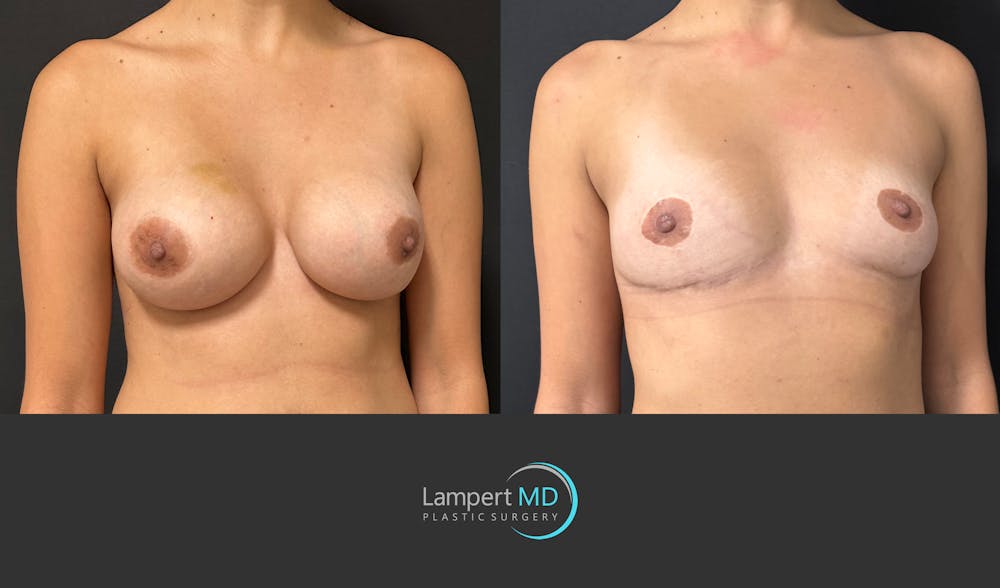 Breast Lift Before & After Gallery - Patient 428959 - Image 3