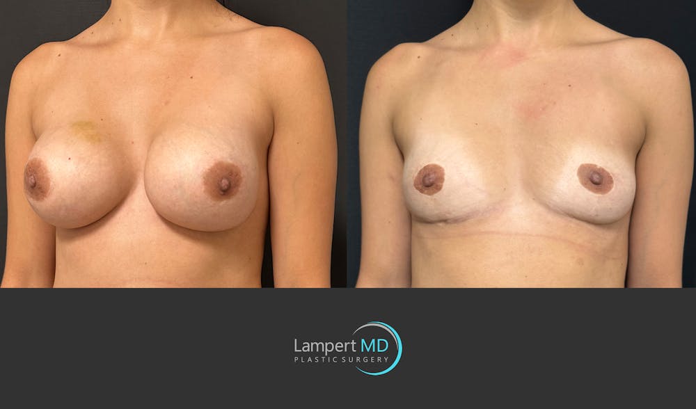Breast Lift Before & After Gallery - Patient 428959 - Image 2