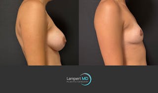 Breast Lift Before & After Gallery - Patient 428959 - Image 5