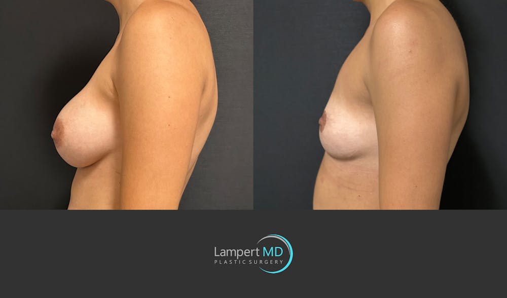Breast Lift Before & After Gallery - Patient 428959 - Image 4