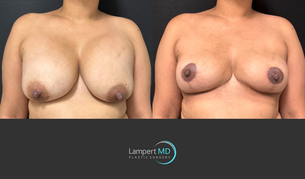 Breast Lift Before & After Gallery - Patient 324909 - Image 3