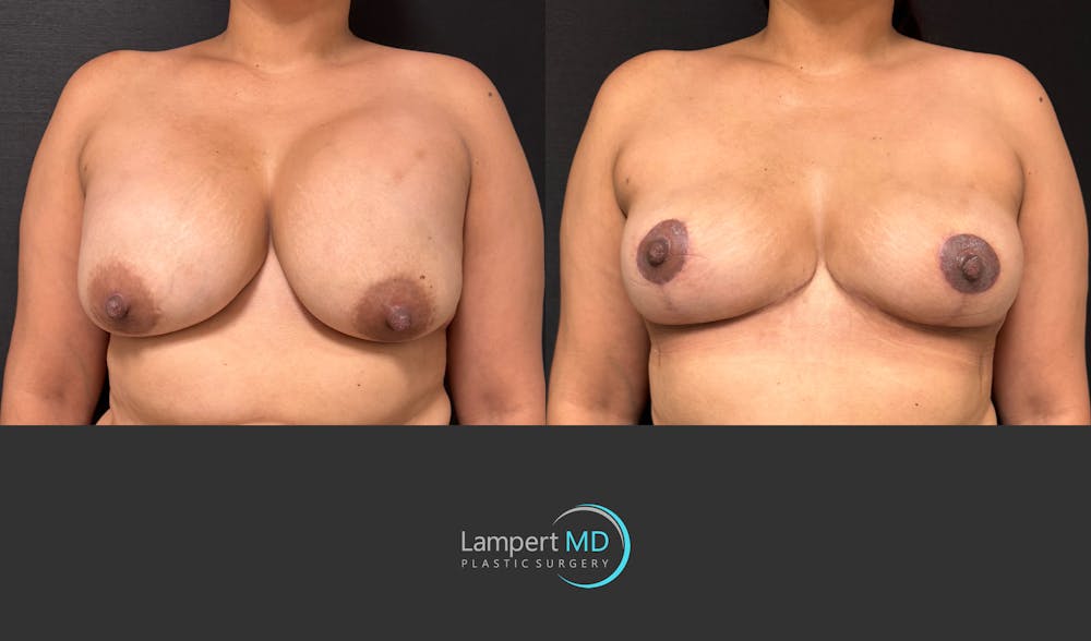 Breast Lift Before & After Gallery - Patient 324909 - Image 1