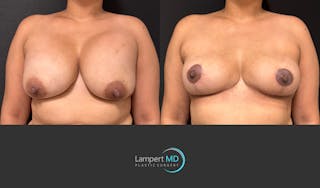 Breast Lift Before & After Gallery - Patient 324909 - Image 1