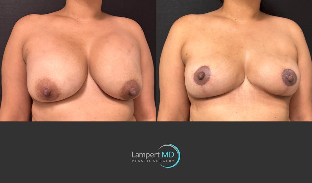 Breast Lift Before & After Gallery - Patient 324909 - Image 2