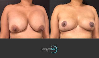 Breast Lift Before & After Gallery - Patient 324909 - Image 2