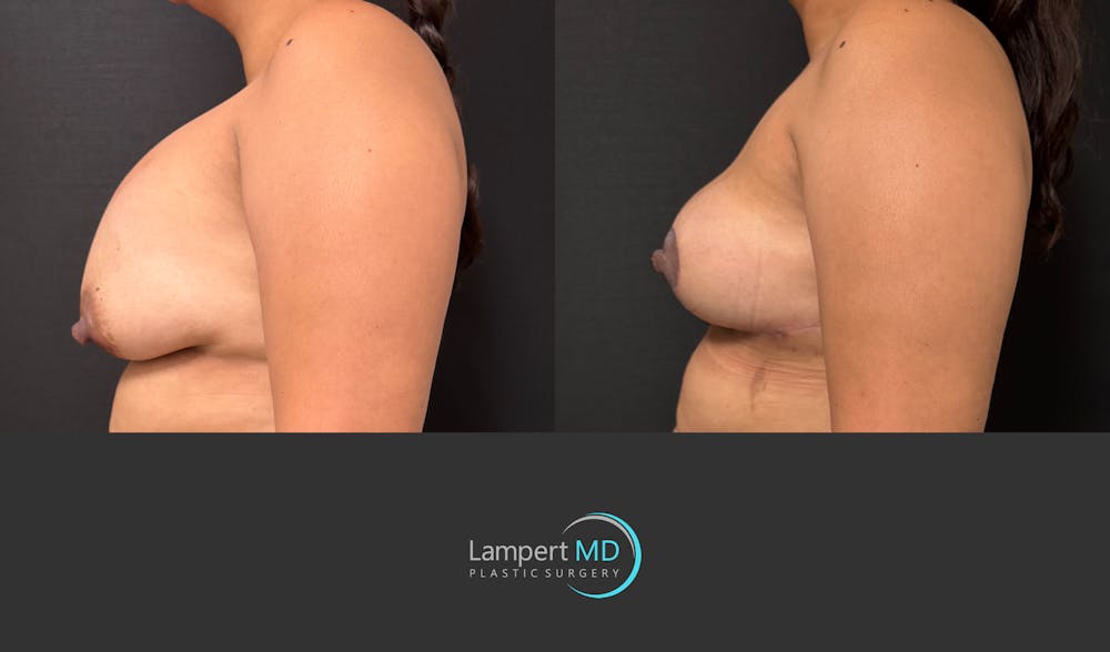 Breast Lift Before & After Gallery - Patient 324909 - Image 4