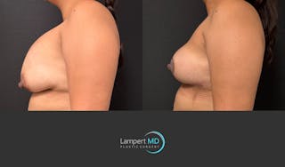 Breast Lift Before & After Gallery - Patient 324909 - Image 4