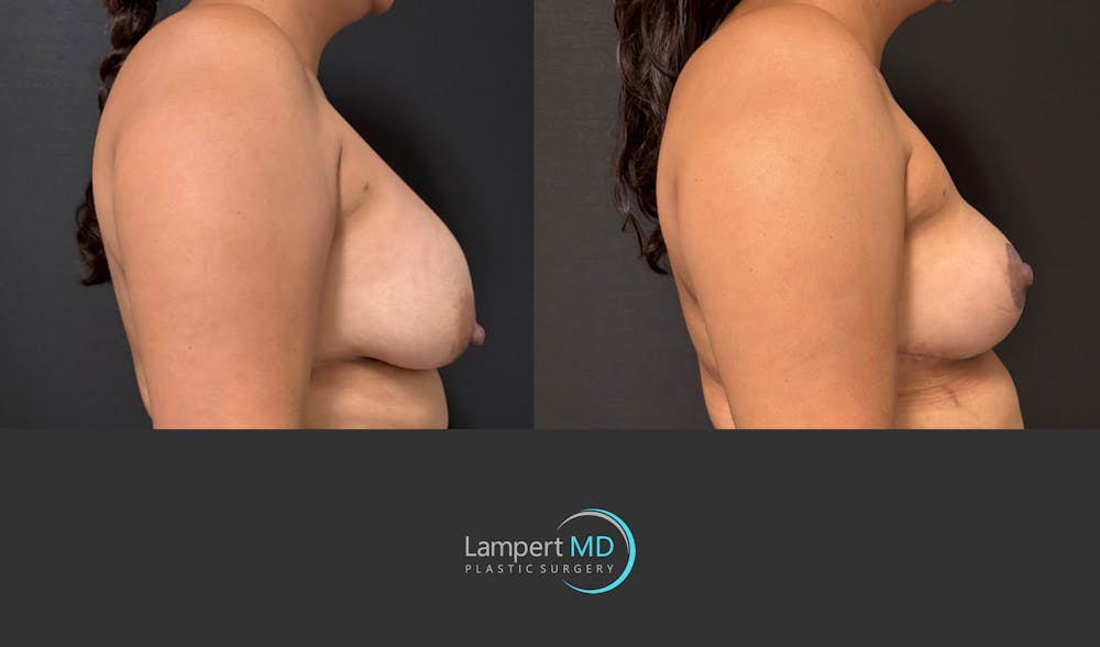 Breast Lift Before & After Gallery - Patient 324909 - Image 5