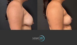 Breast Lift Before & After Gallery - Patient 324909 - Image 5