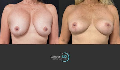 Breast Explant Before & After Gallery - Patient 153334 - Image 1