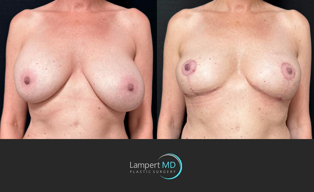 Breast Explant Before & After Gallery - Patient 203924 - Image 1
