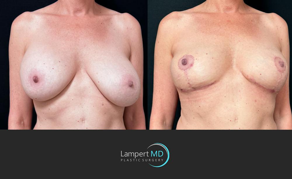 Breast Explant Before & After Gallery - Patient 203924 - Image 3