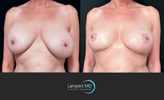 Breast Explant Before & After Gallery - Patient 203924 - Image 2