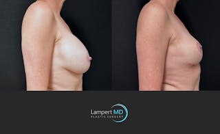 Breast Explant Before & After Gallery - Patient 203924 - Image 4