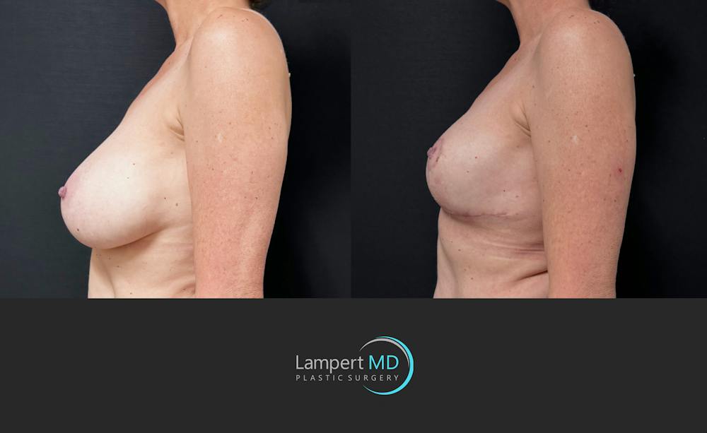 Breast Explant Before & After Gallery - Patient 203924 - Image 5